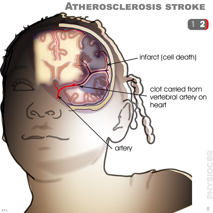 Ischemic stroke is caused by an infarct (cell death) through the passage of a  clot, carried from a vertebral artery, becoming blocked in plaque